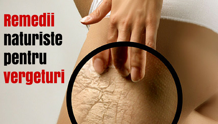 4 remedii naturiste pentru vergeturi