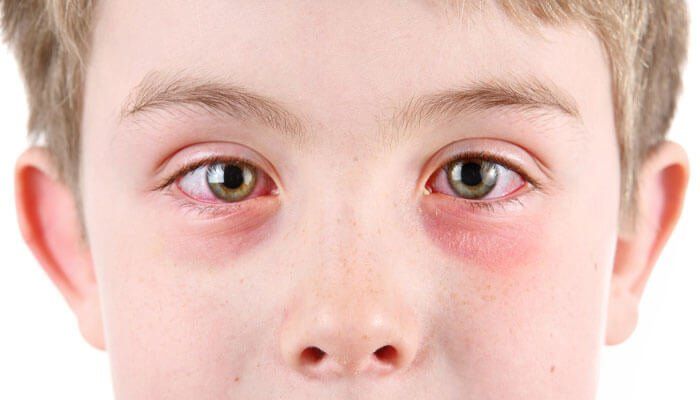 Argint coloidal pentru tratarea conjunctivitei si infectiilor urechii