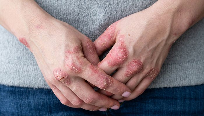 10 remedii naturale pentru ameliorarea psoriazisului 2