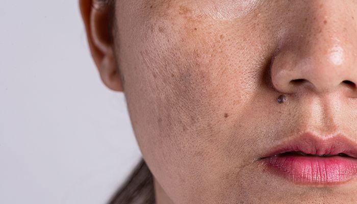 Tenul gras - remedii casnice 2