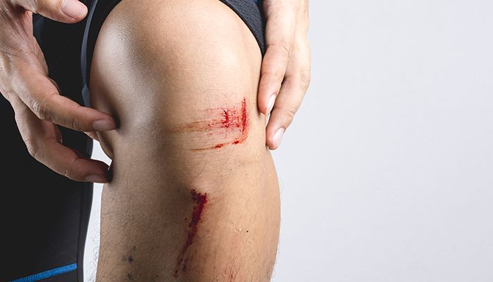 7 moduri de a trata natural o rana infectata 1