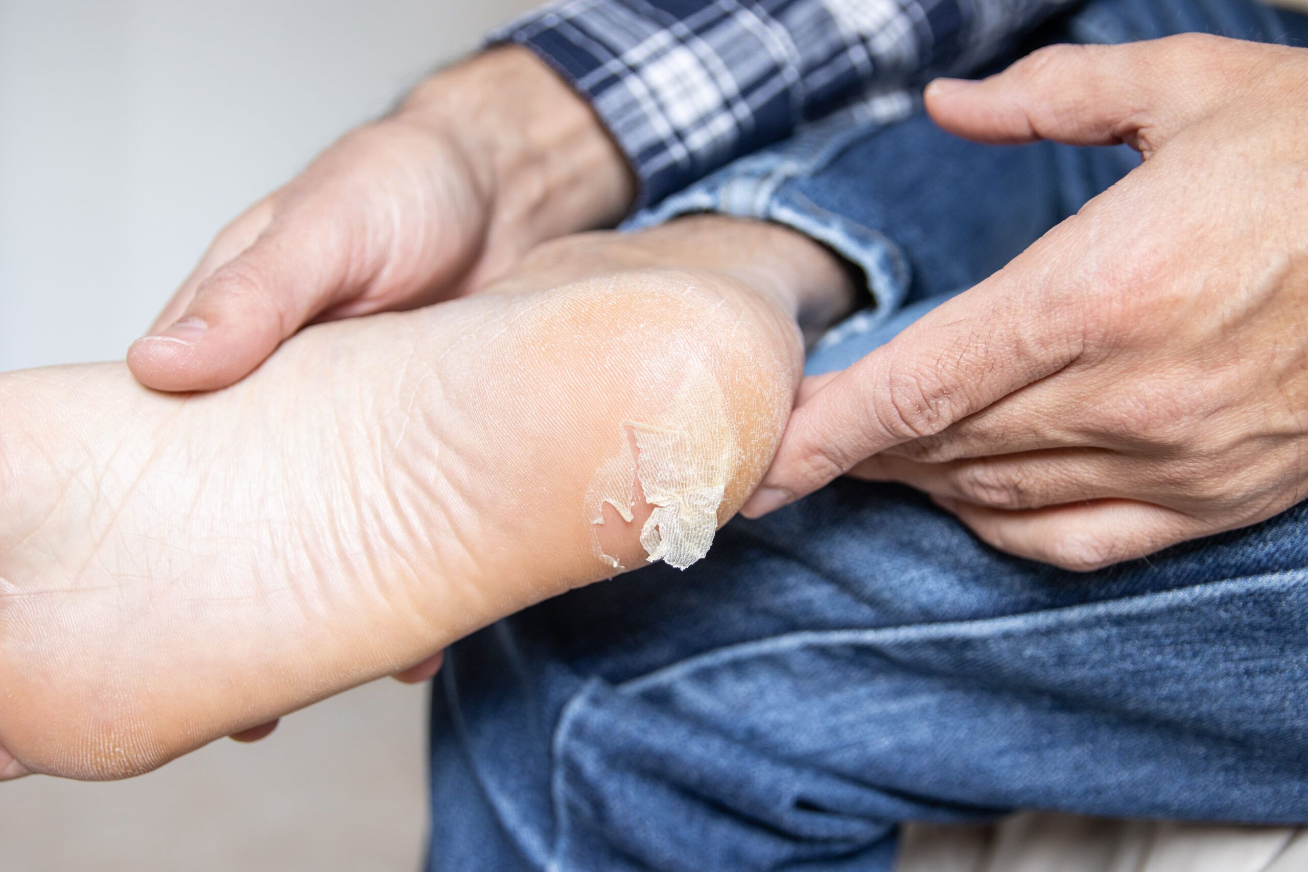 Ce sunt flictenele (basicile) si cum poti scapa de ele?