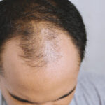 Ti-e teama de chelie? Incearca aceste 24 de remedii casnice 1