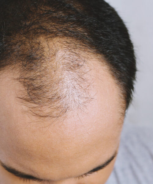 Ti-e teama de chelie? Incearca aceste 24 de remedii casnice