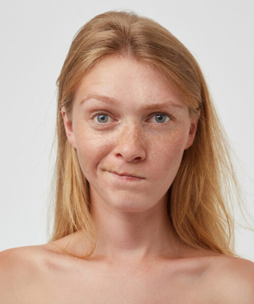 Top 10 remedii naturale pentru inrosirea pielii