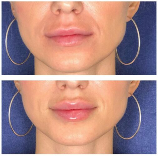 Cum obții buzele la care visezi cu procedura Russian lips 1