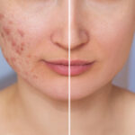 Cum sa folosesti otetul de mere impotriva acneei 1