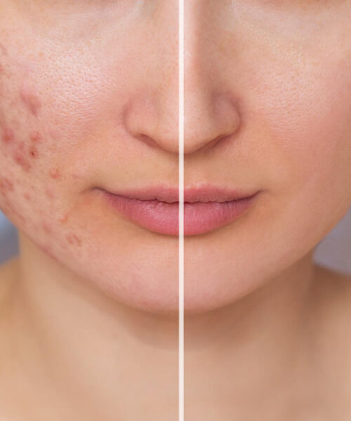 Cum sa folosesti otetul de mere impotriva acneei