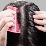 Remedii casnice impotriva scalpului uscat in lunile de iarna 1