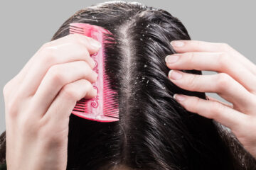 Remedii casnice impotriva scalpului uscat in lunile de iarna