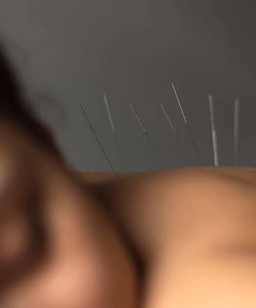 Beneficiile acupuncturii: o terapie sigura si eficienta pentru o gama larga de afectiuni