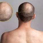 Recâștigă-ți încrederea cu ajutorul unui implant de păr 1