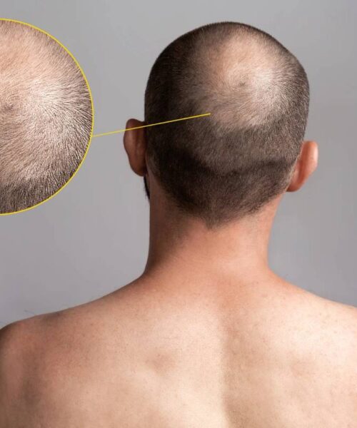 Recâștigă-ți încrederea cu ajutorul unui implant de păr