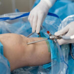 Care sunt cele mai importante avantaje ale artroscopiei? 1