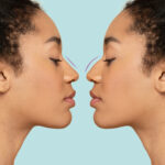 Rinoplastia Dezvăluită: Top 5 Informații Cheie pentru Pacienți
