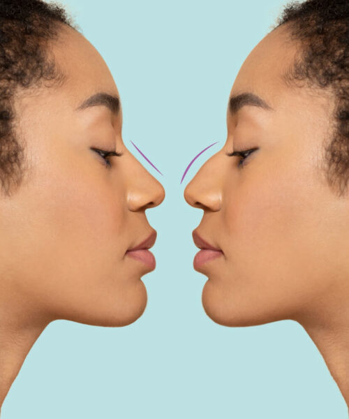 Rinoplastia Dezvăluită: Top 5 Informații Cheie pentru Pacienți