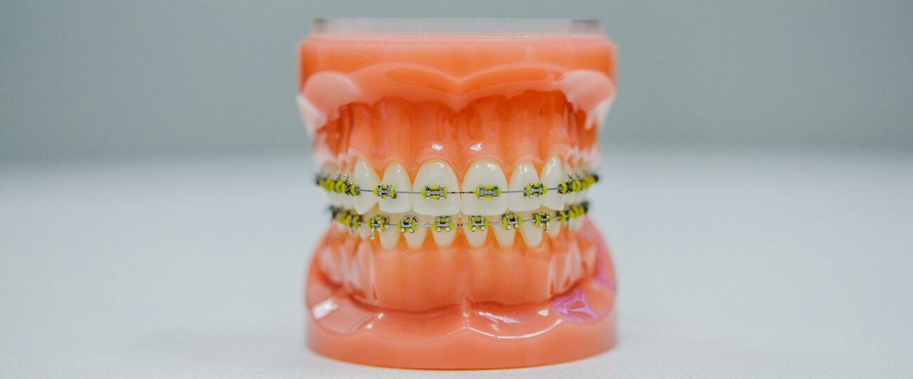 Cum să alegi cel mai potrivit aparat dentar pentru tine?