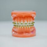 Cum să alegi cel mai potrivit aparat dentar pentru tine