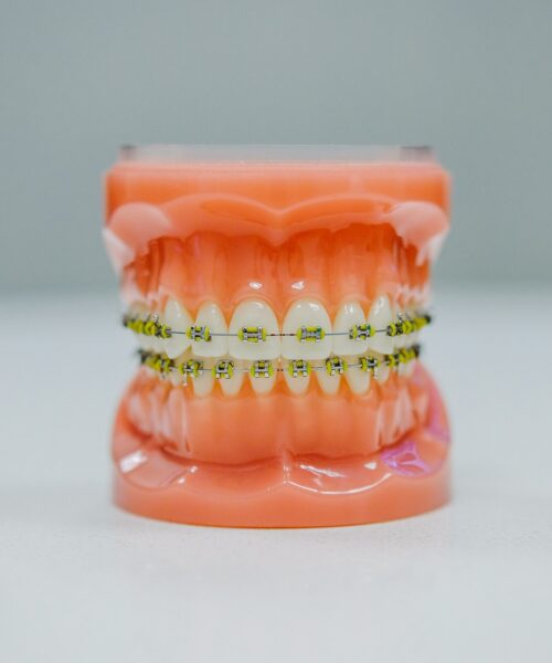 Cum să alegi cel mai potrivit aparat dentar pentru tine?